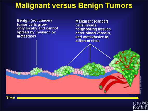 Benign and Malignant Tumors What is the Difference?