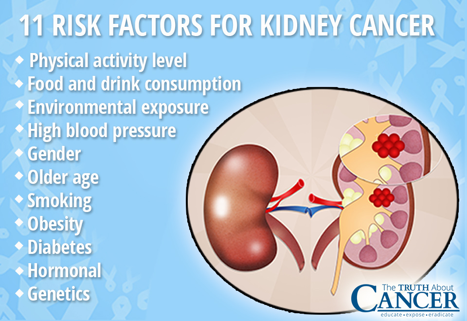 Kidney-Cancer-causes-11-risks-for-kidney-cancer-ttac