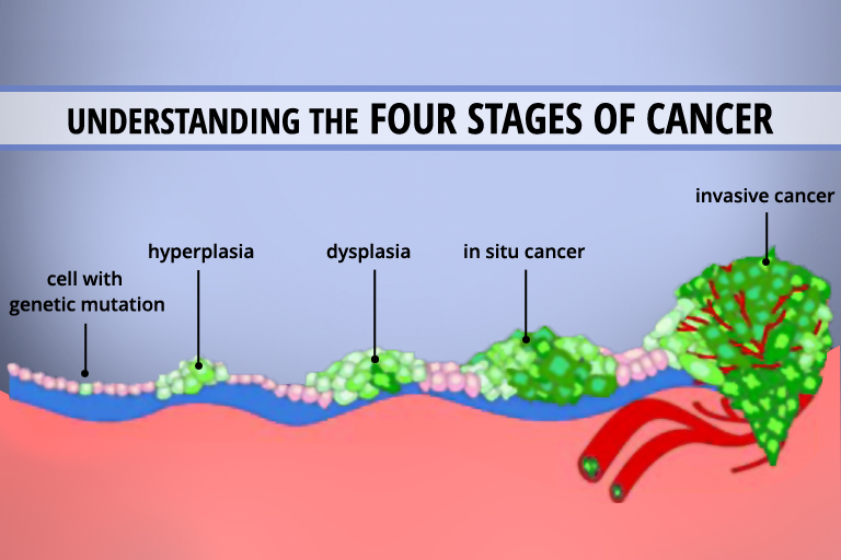 cancer-staging-the-petree-blog