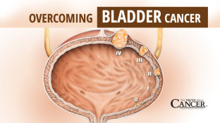 Overcoming Bladder Cancer
