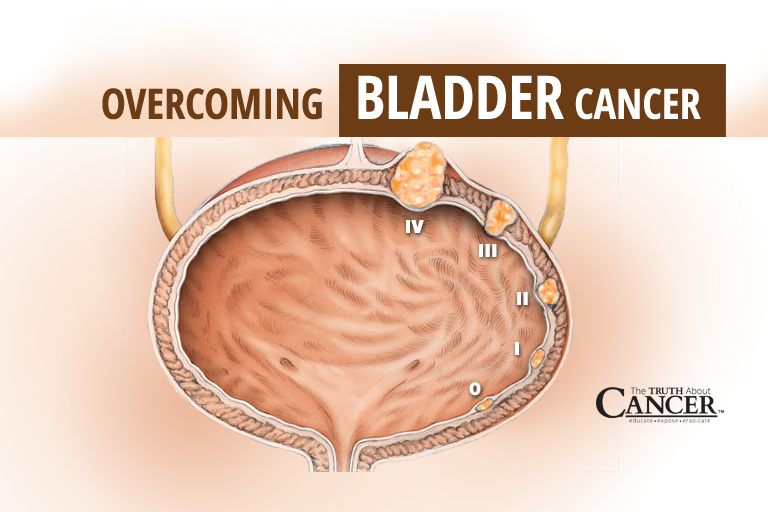 Overcoming Bladder Cancer