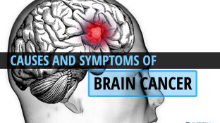 Causes and Symptoms of Brain Cancer