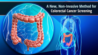A New, Non-Invasive Method for Colorectal Cancer Screening