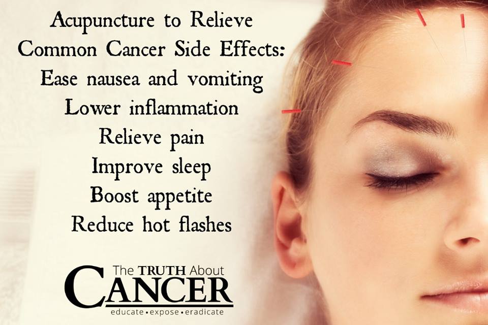 Acupuncture relieves common cancer side effects