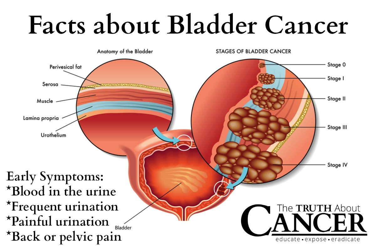 Some Facts About Bladder Cancer.