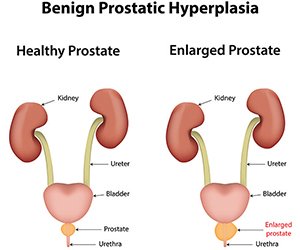 An enlarged prostate often leads to difficulty with urination