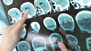 7 Strategies for Preventing & Healing Brain Tumors