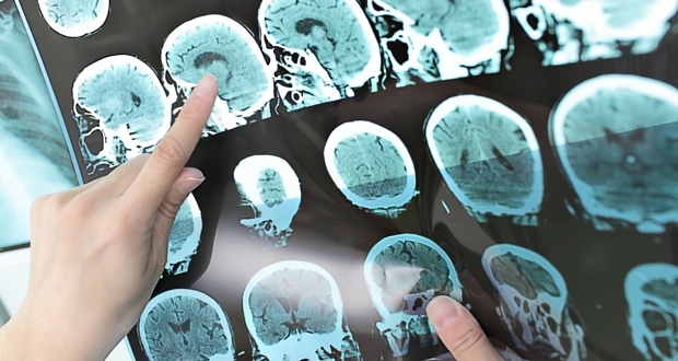 7 Strategies for Preventing & Healing Brain Tumors