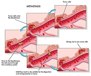 Metastatic Prostate Cancer