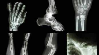 PEMF therapy for bone fractures