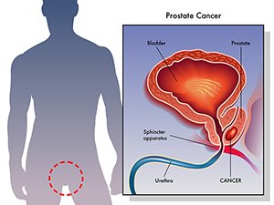 Prostate cancer develops when gland cells in the prostate begin to grow uncontrollably