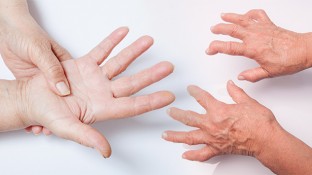 Rheumatoid Arthritis and Cancer: What's the Connection?
