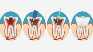 Are Root Canals Really a Cause of Cancer?
