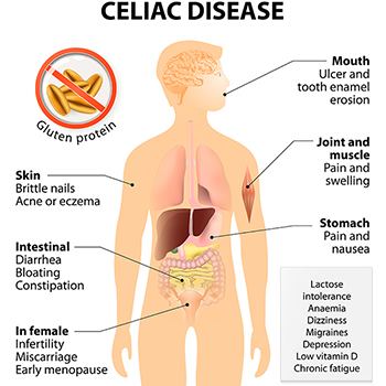 Coeliac disease or celiac disease or celiac sprue. Signs and Symptoms. Human silhouette with highlighted internal organs