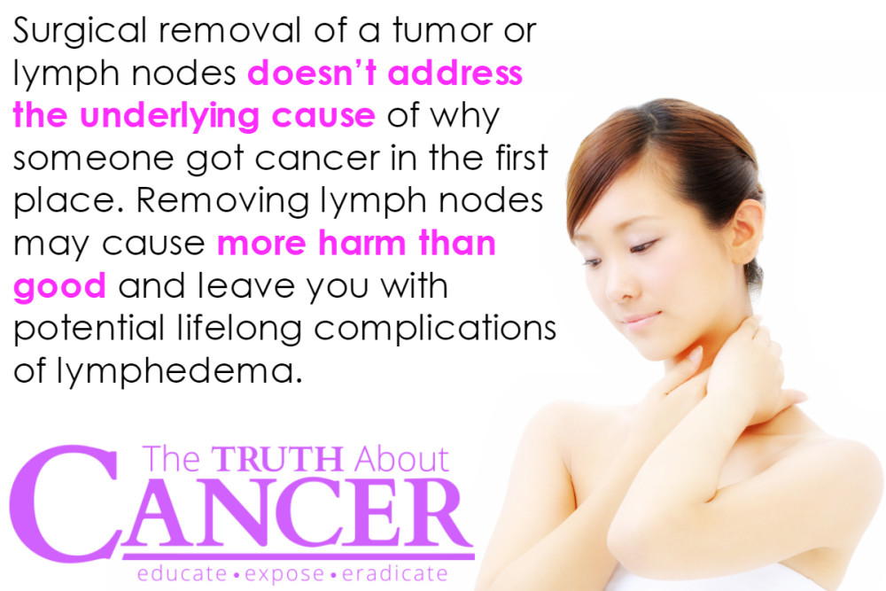 lymph node removal