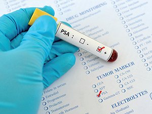 The PSA test is not a reliable indicator of prostate cancer as there are many factors that can elevate PSA levels