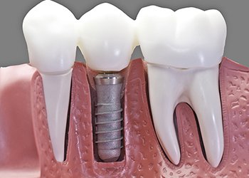 Titanium, often used for dental implants, can still contain heavy metals