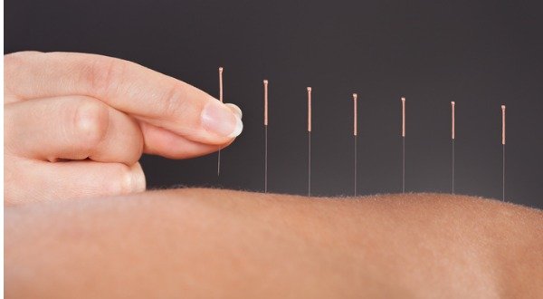 Acupuncture vs. Opioids: The Best Choice for Pain Relief