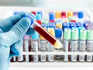 Specialized blood tests are used to detect factors of chronic inflammation