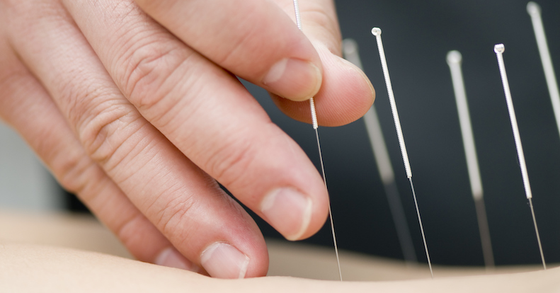 Doctor uses acupuncture for treatment of the patient
