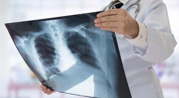 Lung Cancer: Causes and Promising Natural Solutions